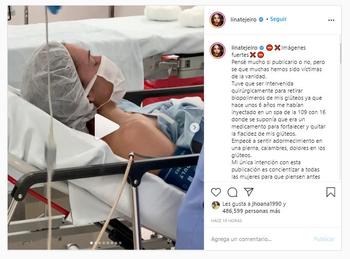 Lina Tejeiro tuvo que ser operada de urgencia por biopolímeros