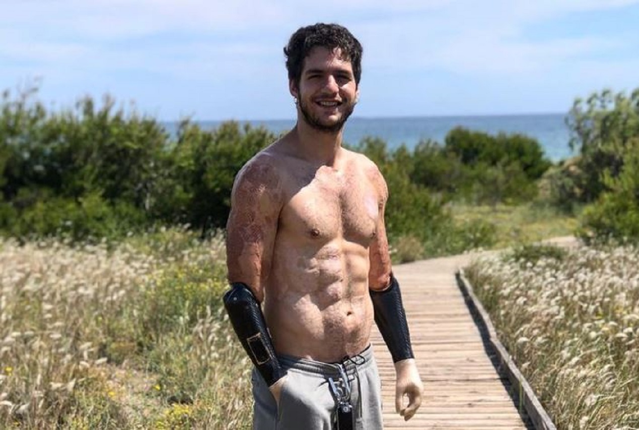 Davide Morana, el hombre que perdió sus extremidades y se volvió un ejemplo de superación