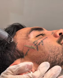 Mateo Carvajal en procedimiento para borrar su tatuaje. Crédito: @mateoc17