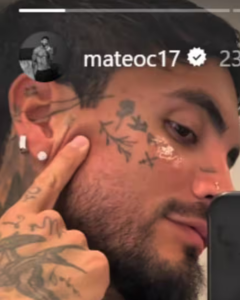 Así quedó Carvajal luego de su procedimiento. Crédito:@mateoc17