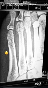 Fractura de Laura de León. | Crédito: @Lauradeleon