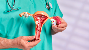 Cáncer de ovario